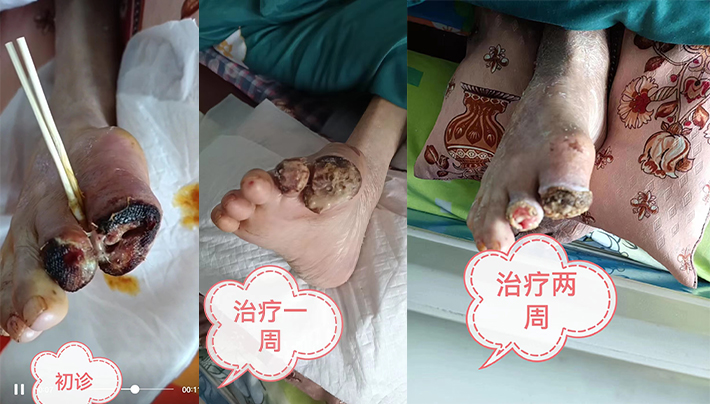 难愈合伤口