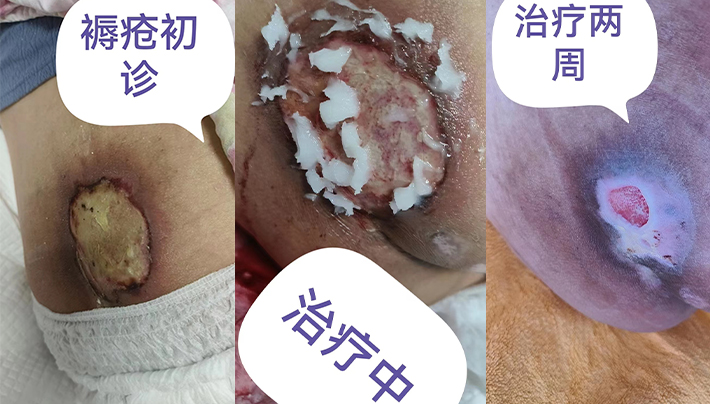 痔疮